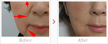 qA_(X`-Restylane 1ml)@ߐ@Ȃ