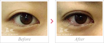 目の上の脂肪除去術