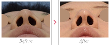 鼻尖形成術3D法