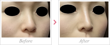 鼻尖形成術(オープン法)