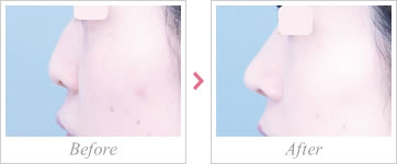 鼻尖形成術3D法＋耳軟骨移植