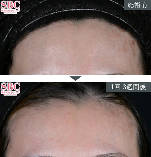 D~W+{gbNX~Ǘʐ^izj1 Before After