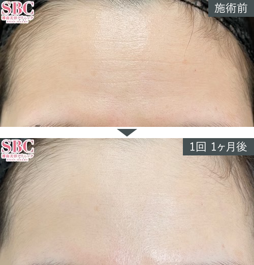 D~W+{gbNX~Ǘʐ^izj2 Before After
