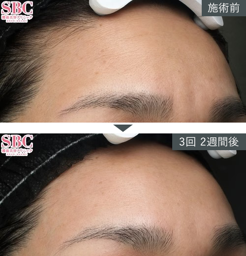 D~W+{gbNX~Ǘʐ^izj4 Before After