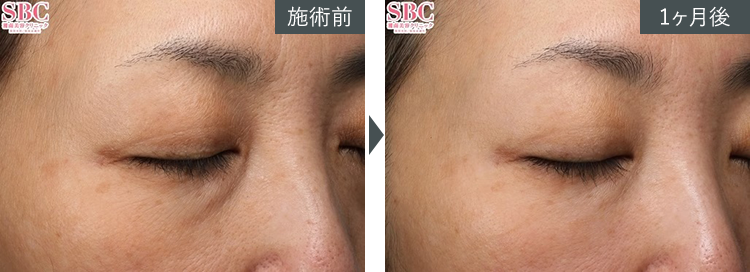 D~W+{gbNX~Ǘʐ^izj4 Before After