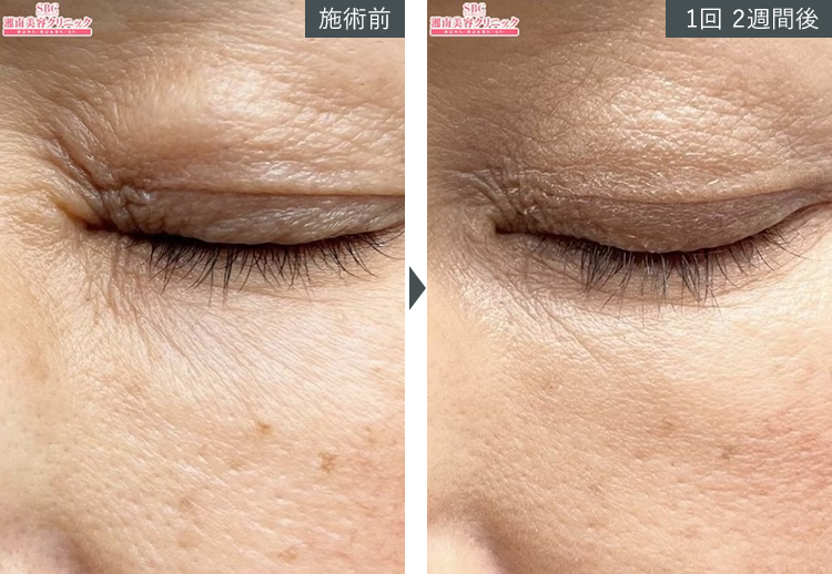 D~W+{gbNX~Ǘʐ^izj4 Before After