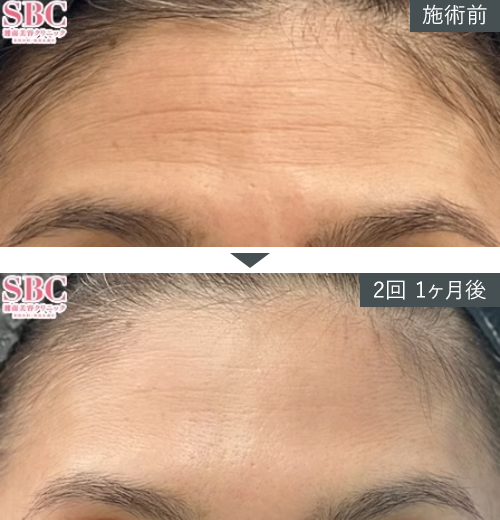 D~W+{gbNX~Ǘʐ^izj4 Before After