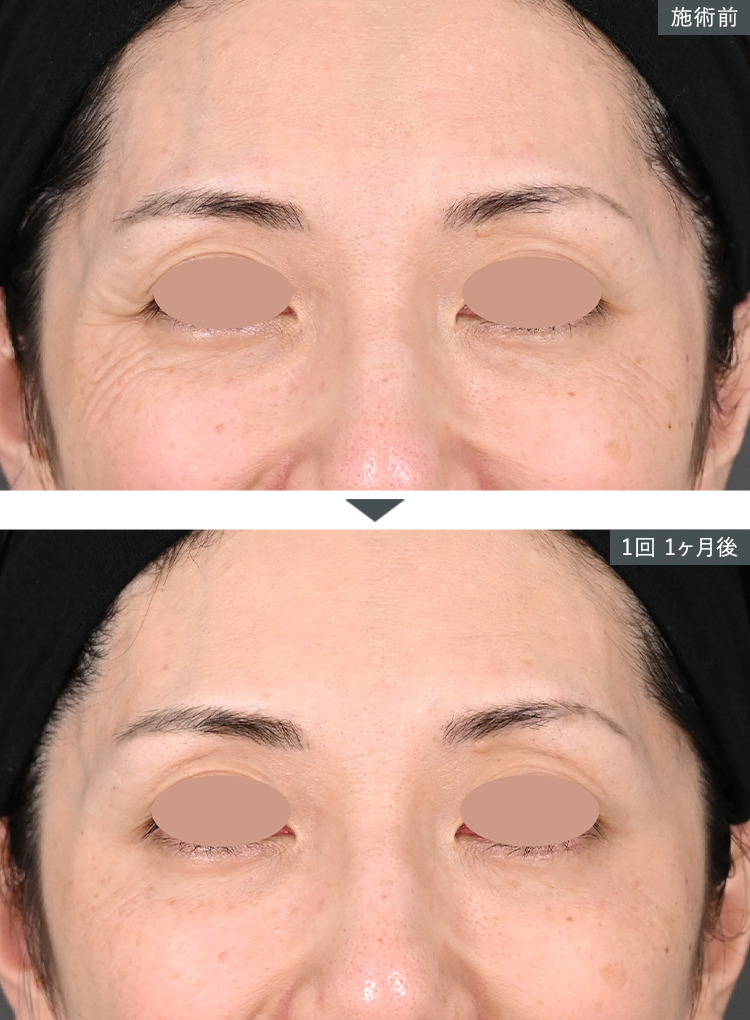 D~W+{gbNX~Ǘʐ^iڌj Before After