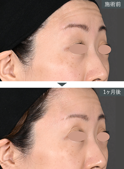 D~W+{gbNX~Ǘʐ^izj Before After