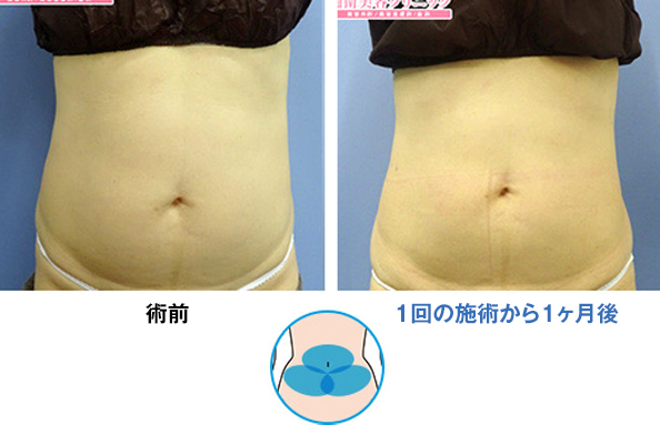PickUp症例写真3 腹部 1回の施術から1ヶ月後 n198790