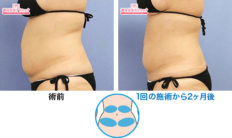 症例写真12 腹部 1回の施術から2ヶ月後 n190377